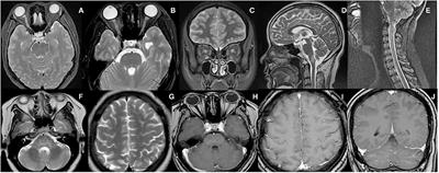 Clinical Profile and Treatment Outcome in MOGAD: A Single-Center Case-Series Study in Guiyang, China